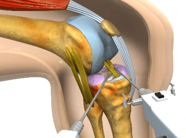 procedure-img-1