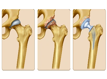 arthroscopic