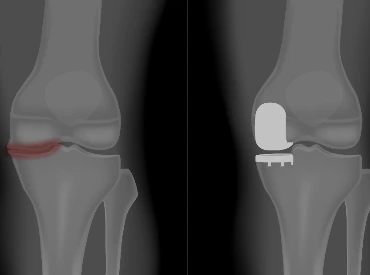knee replacement