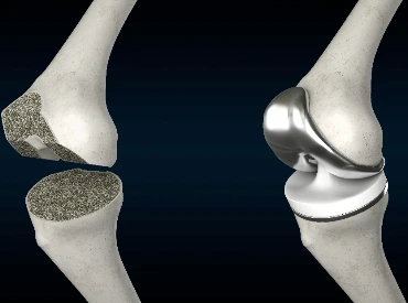 total knee replace
