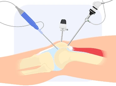 knee arthroscopy